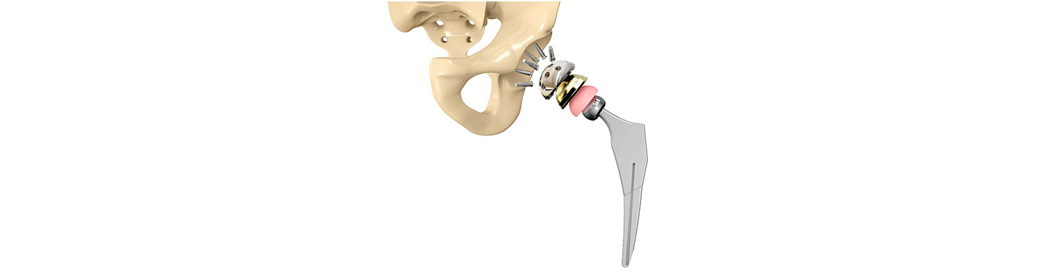 Zimmer Biomet Asks To Toss $3.55M Hip Implant Verdict