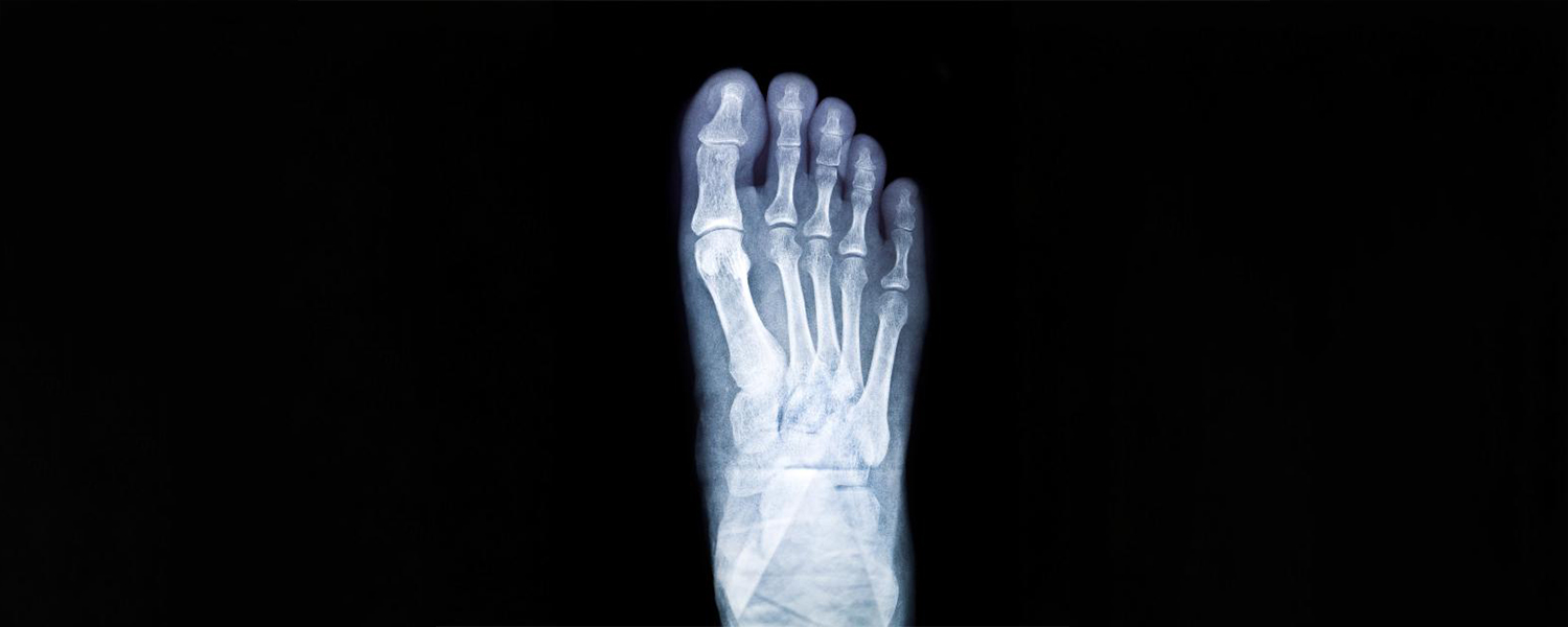 Big Toe Surgery Patients Report Cartiva Implant Failures