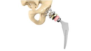 MI Judge Refuses To Dismiss A Biomet Hip Replacement Case